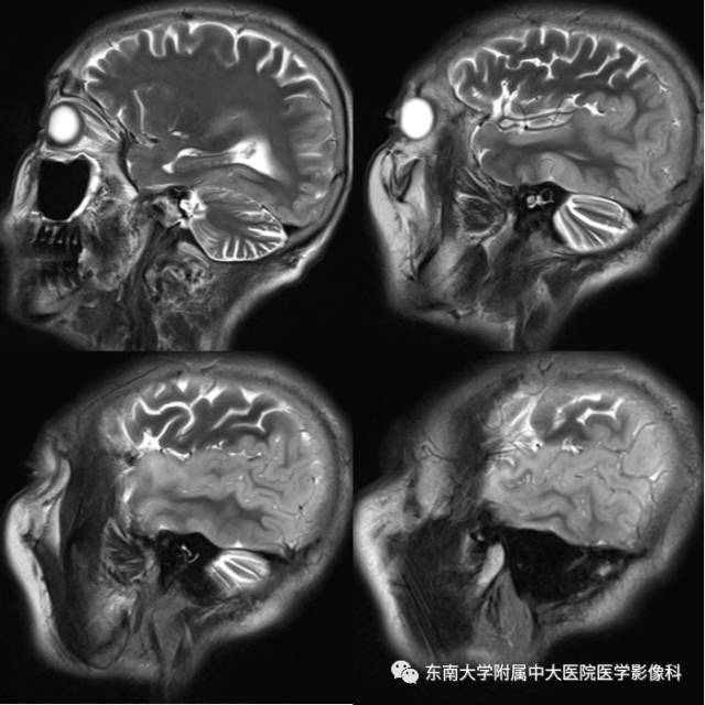 【病例】线粒体脑肌病1例MR影像诊断