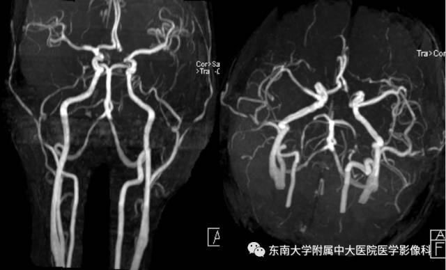 【病例】线粒体脑肌病1例MR影像诊断