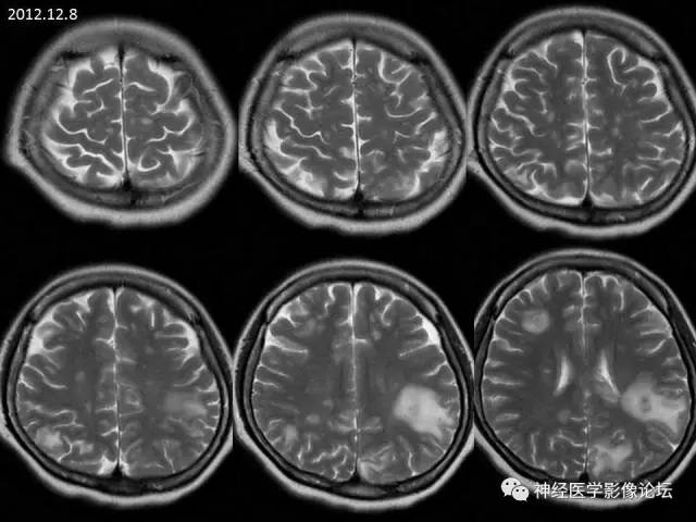 【病例】脑结核1例MR影像诊断