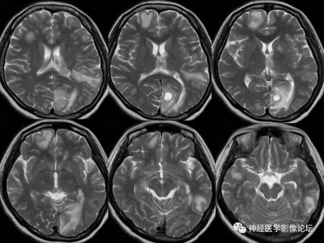 【病例】脑结核1例MR影像诊断