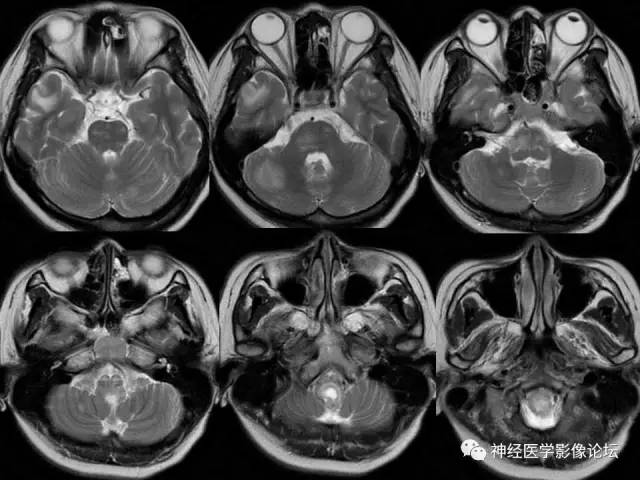 【病例】脑结核1例MR影像诊断