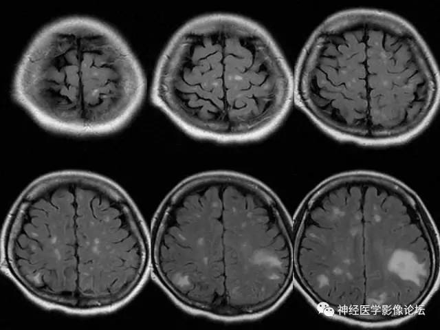 【病例】脑结核1例MR影像诊断