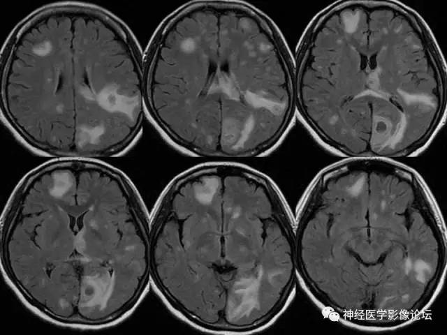 【病例】脑结核1例MR影像诊断