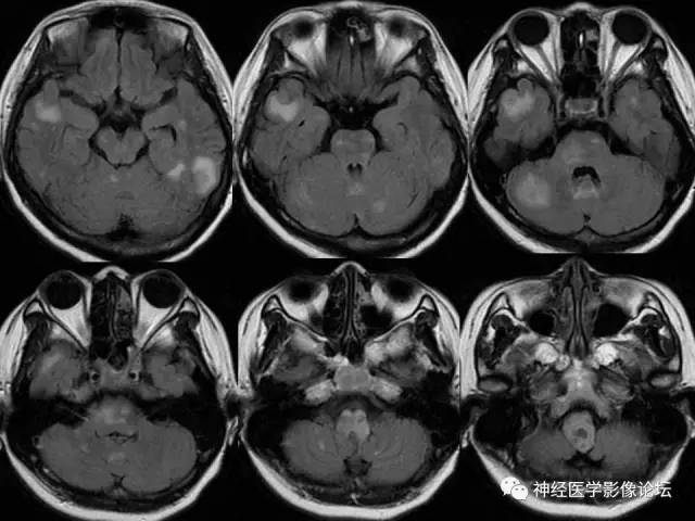 【病例】脑结核1例MR影像诊断