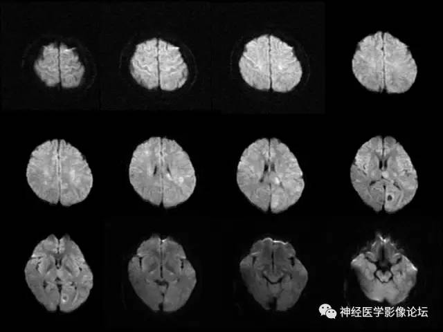 【病例】脑结核1例MR影像诊断