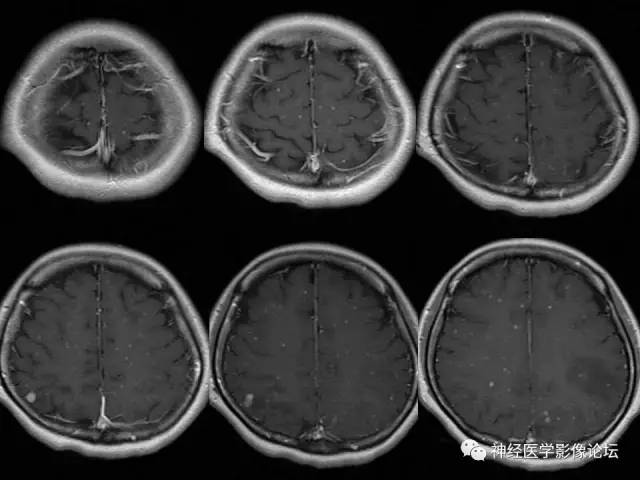 【病例】脑结核1例MR影像诊断