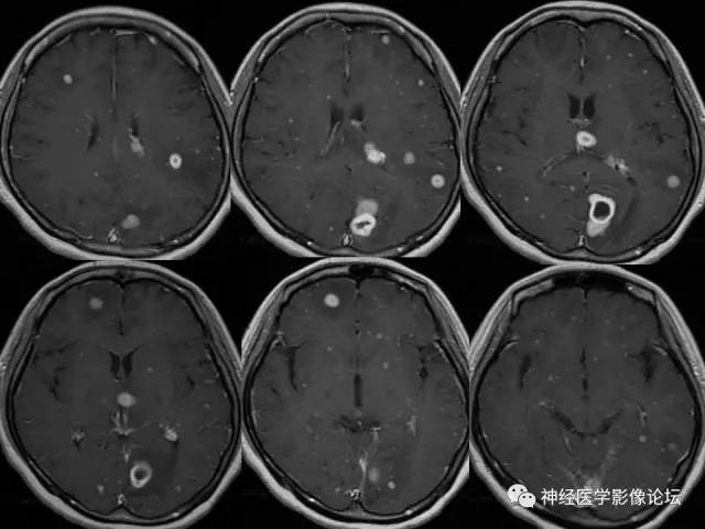 【病例】脑结核1例MR影像诊断