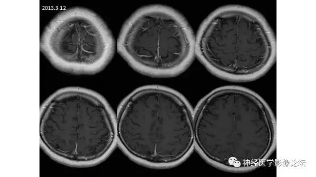 【病例】脑结核1例MR影像诊断
