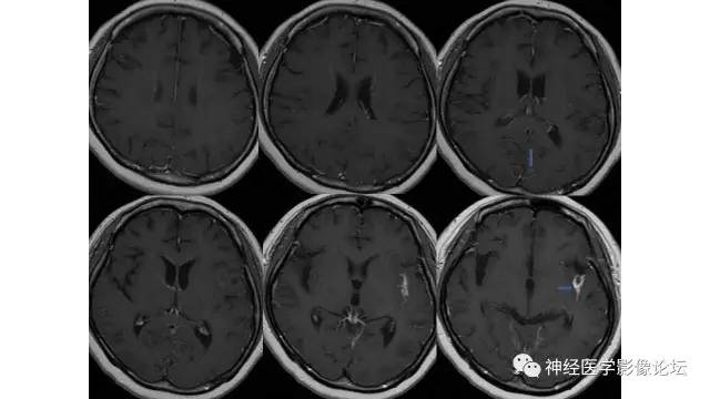 【病例】脑结核1例MR影像诊断