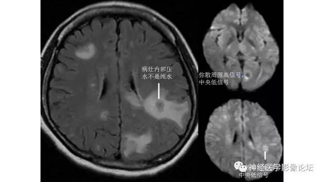 【病例】脑结核1例MR影像诊断