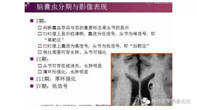 【病例】脑结核1例MR影像诊断