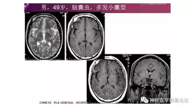 【病例】脑结核1例MR影像诊断