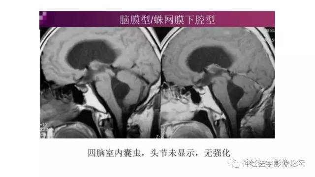【病例】脑结核1例MR影像诊断