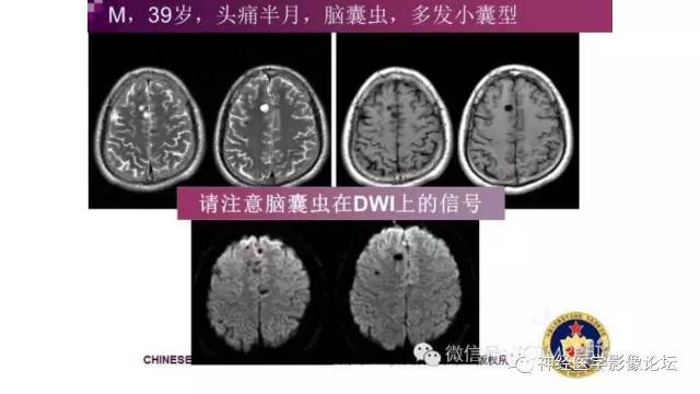 【病例】脑结核1例MR影像诊断