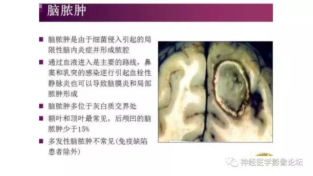 【病例】脑结核1例MR影像诊断