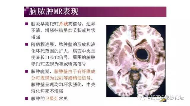 【病例】脑结核1例MR影像诊断