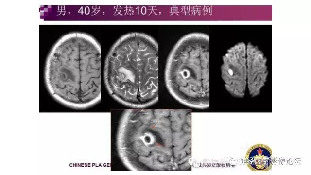 【病例】脑结核1例MR影像诊断