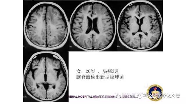 【病例】脑结核1例MR影像诊断