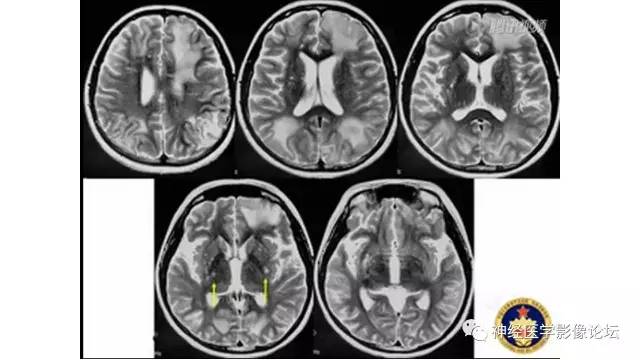 【病例】脑结核1例MR影像诊断