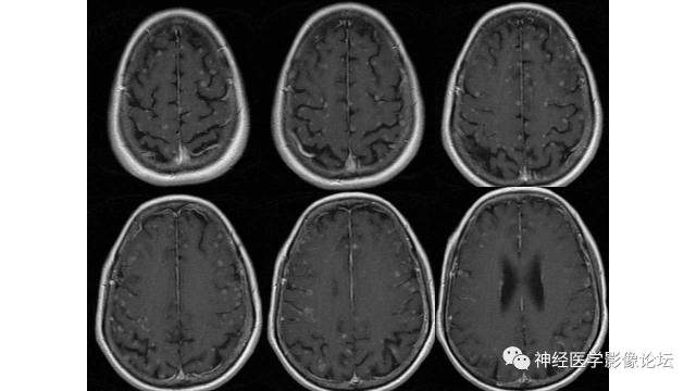 【病例】脑结核1例MR影像诊断