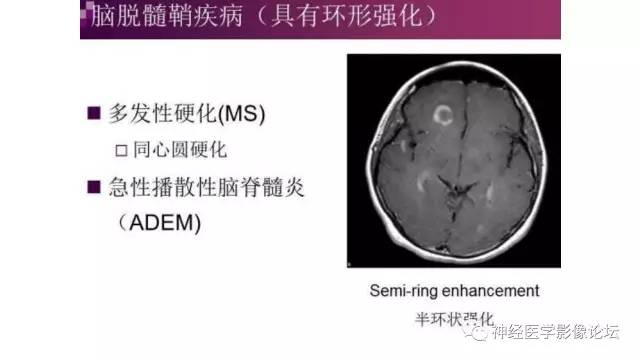 【病例】脑结核1例MR影像诊断