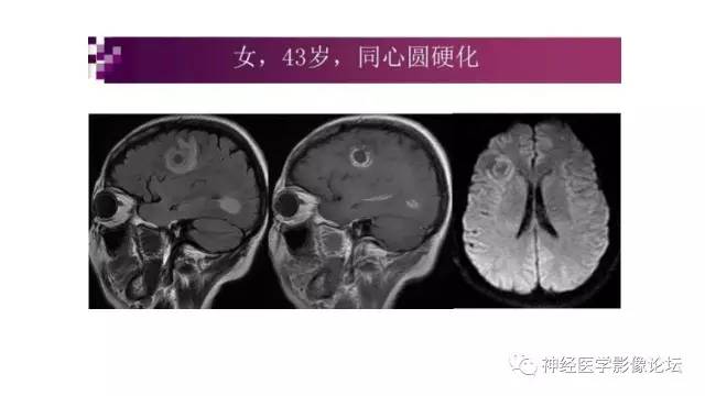 【病例】脑结核1例MR影像诊断