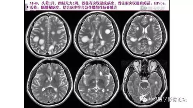 【病例】脑结核1例MR影像诊断