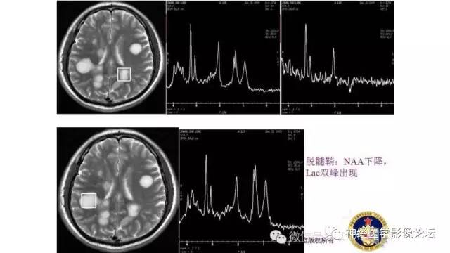 【病例】脑结核1例MR影像诊断