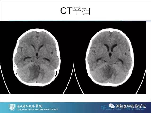 【病例】小脑半球髓母细胞瘤1例MR