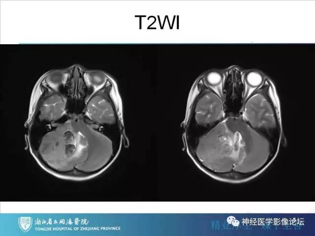 【病例】小脑半球髓母细胞瘤1例MR