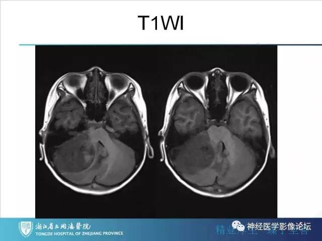 【病例】小脑半球髓母细胞瘤1例MR