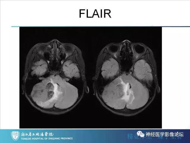 【病例】小脑半球髓母细胞瘤1例MR