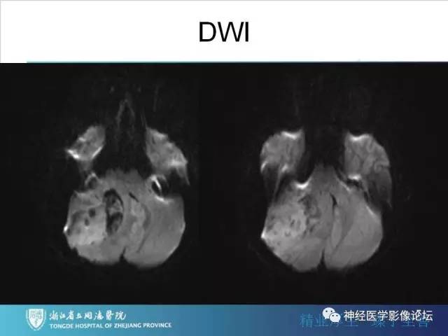 【病例】小脑半球髓母细胞瘤1例MR