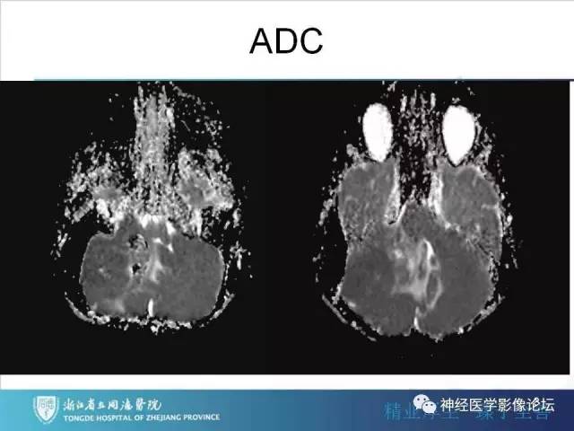 【病例】小脑半球髓母细胞瘤1例MR