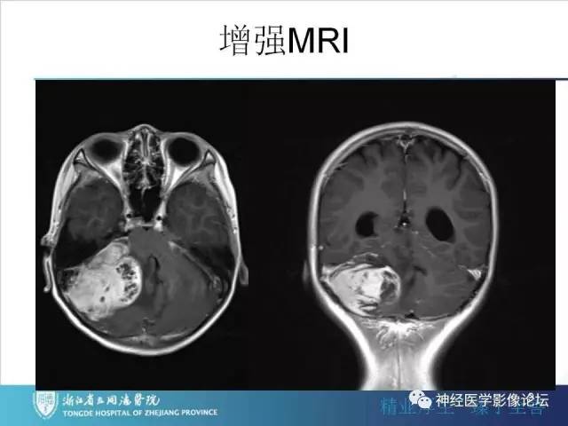 【病例】小脑半球髓母细胞瘤1例MR