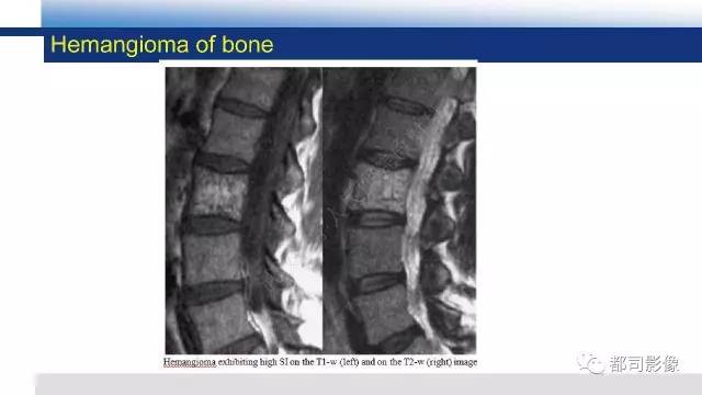 【PPT】脊柱良性肿瘤及肿瘤样病变影像诊断