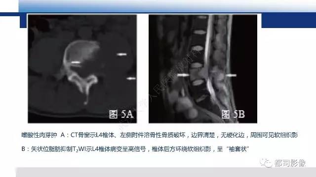 【PPT】脊柱良性肿瘤及肿瘤样病变影像诊断