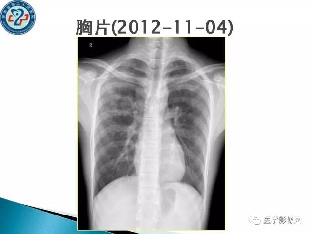 【病例】肺结核?还是不典型的肺泡蛋白沉着症?请你鉴别 【病例】肺结核?还是不典型的肺泡蛋白沉着症?请你鉴别