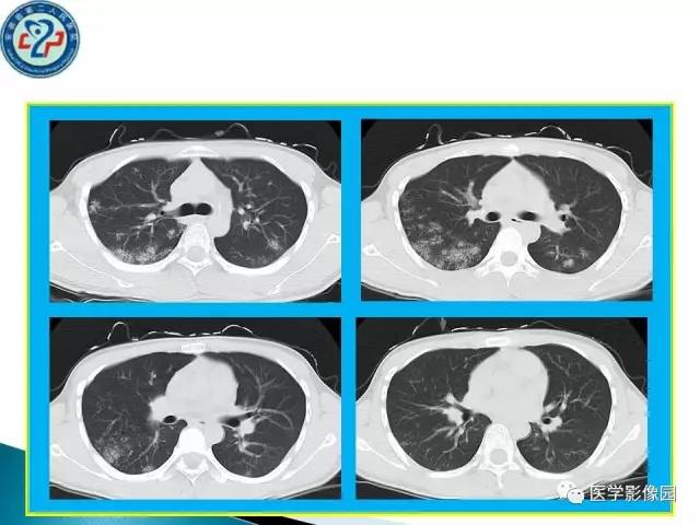 【病例】肺结核?还是不典型的肺泡蛋白沉着症?请你鉴别 【病例】肺结核?还是不典型的肺泡蛋白沉着症?请你鉴别