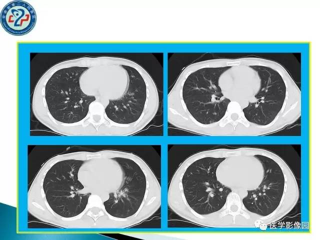 【病例】肺结核?还是不典型的肺泡蛋白沉着症?请你鉴别 【病例】肺结核?还是不典型的肺泡蛋白沉着症?请你鉴别