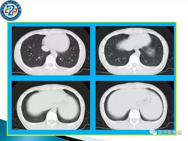 【病例】肺结核?还是不典型的肺泡蛋白沉着症?请你鉴别 【病例】肺结核?还是不典型的肺泡蛋白沉着症?请你鉴别