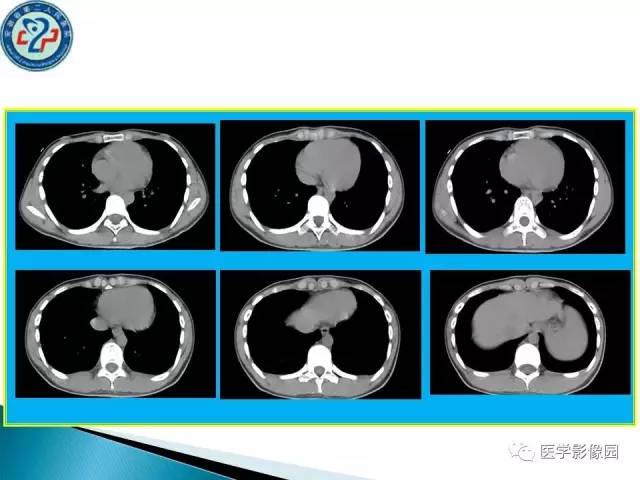 【病例】肺结核?还是不典型的肺泡蛋白沉着症?请你鉴别 【病例】肺结核?还是不典型的肺泡蛋白沉着症?请你鉴别