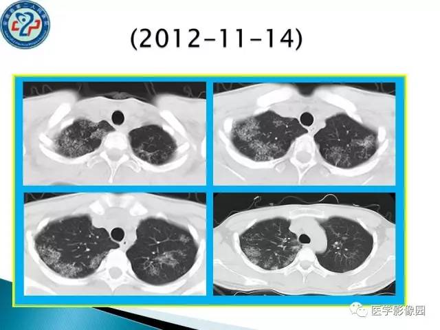 【病例】肺结核?还是不典型的肺泡蛋白沉着症?请你鉴别 【病例】肺结核?还是不典型的肺泡蛋白沉着症?请你鉴别