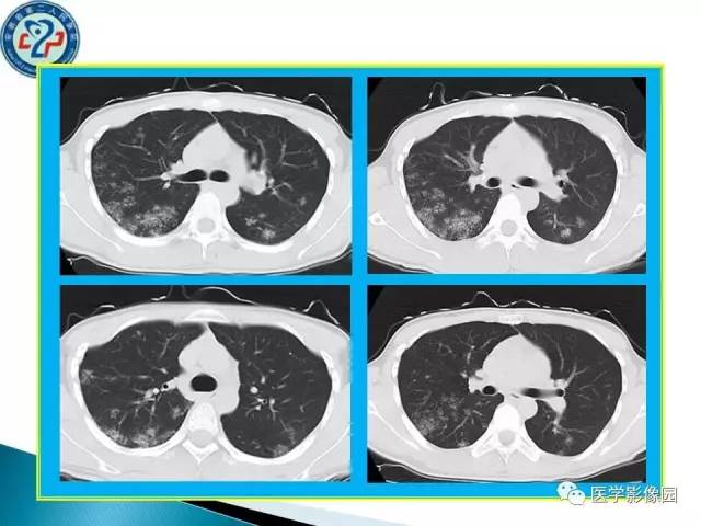 【病例】肺结核?还是不典型的肺泡蛋白沉着症?请你鉴别 【病例】肺结核?还是不典型的肺泡蛋白沉着症?请你鉴别