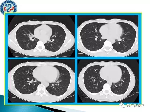 【病例】肺结核?还是不典型的肺泡蛋白沉着症?请你鉴别 【病例】肺结核?还是不典型的肺泡蛋白沉着症?请你鉴别