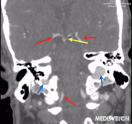 【病例】基底动脉尖综合征1例CT