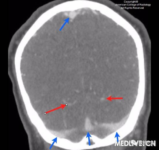 【病例】基底动脉尖综合征1例CT