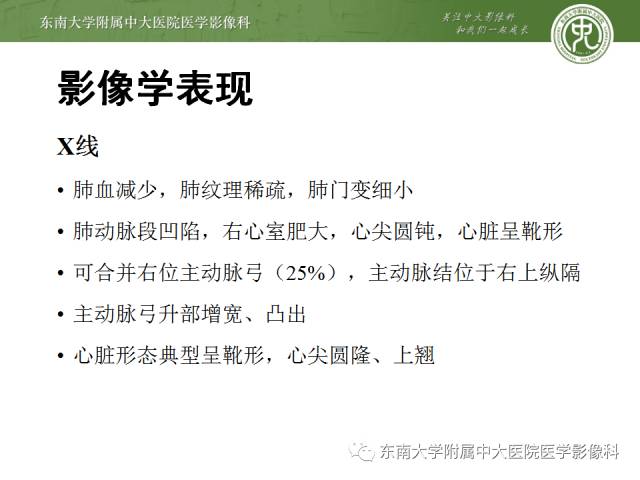 【病例】先心病法洛氏四联症1例CT三维重建