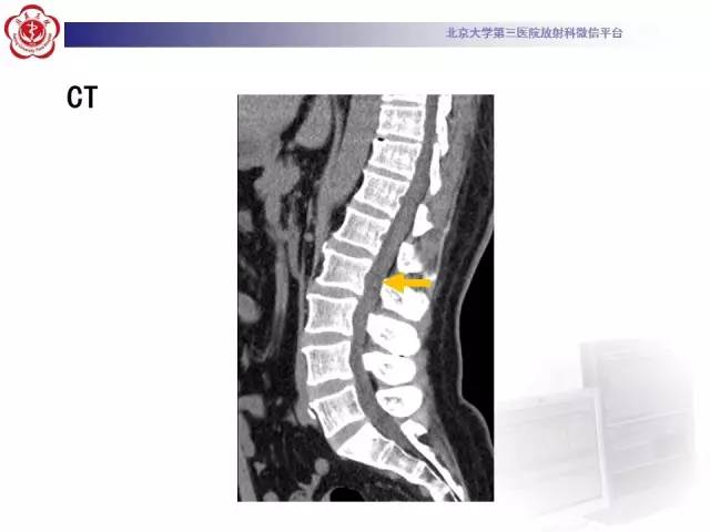 【病例】椎管内粘液乳头型室管膜瘤1例CT及MR