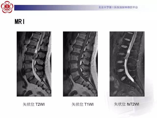 【病例】椎管内粘液乳头型室管膜瘤1例CT及MR